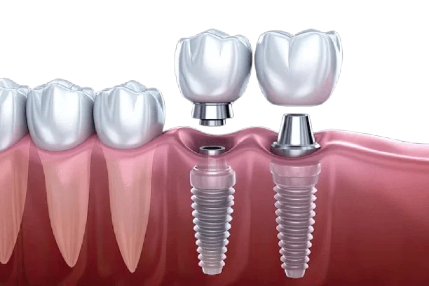 IMPLANTS