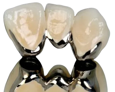 CAD/CAM PFM